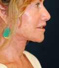 Feel Beautiful - Necklift 207 - After Photo